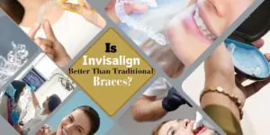 Traditional Braces